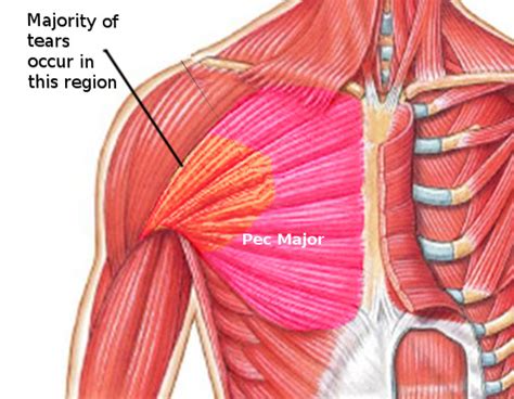 pectoralis major lappen|Pectoralis major (anatomy)